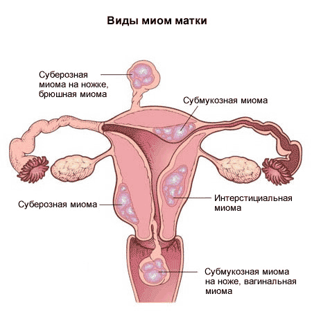 миома матки клиника