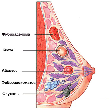 fibroadenoma molochnoi zhelezy