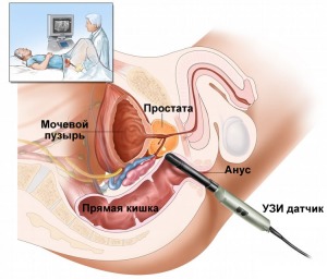 УЗИ простаты 